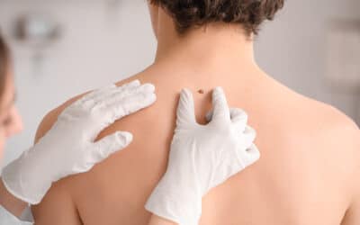 Az anyajegyszűrés titka – Ne csak a veszélyt lássa, hanem a megelőzést is!